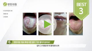 2016-11-02 베체트병 치료기간 3개월.jpg
