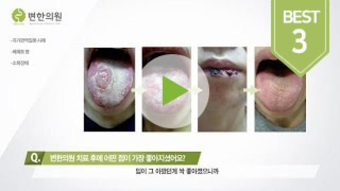2016-11-02 베체트병 치료기간 3개월.jpg