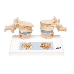 3B 인체모형 골다공증모형 A95 흉추모형 골밀도비교모형