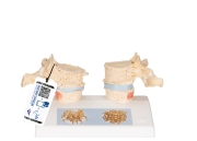 3B 인체모형 골다공증 모형 A95 흉추모형 골밀도비교모형 Osteoporosis Model