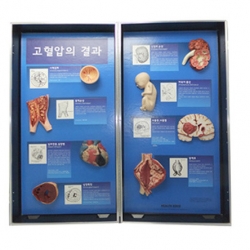 고혈압의 결과모형 (78927) HEALTH  EDCO 79649 고혈압합병증판넬모형 고혈압예방교육