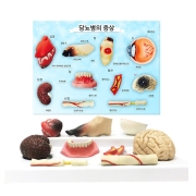 당뇨병에 의한 질병 (3D) (78792) 당뇨합병증모형